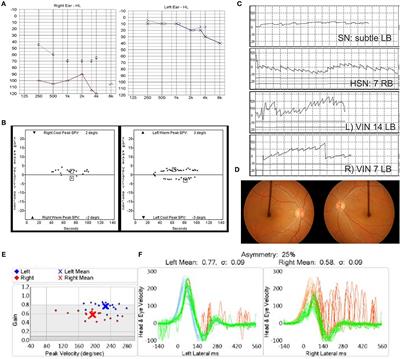 Bechterew's Phenomenon in Bilateral Sequential Vestibular Neuritis: A Report of Two Cases